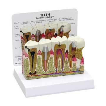 Picture of Model, Diseased Teeth & Gums 