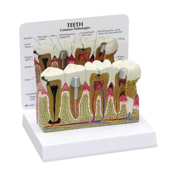 Picture of Model, Diseased Teeth & Gums 